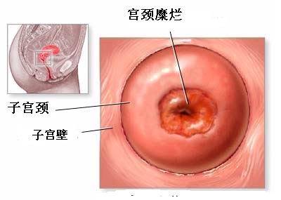 宫颈糜烂