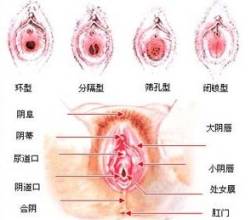 外阴炎