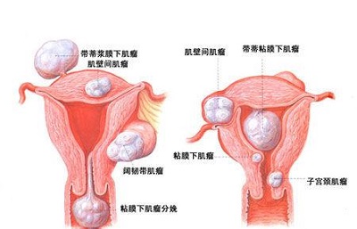 盆腔炎