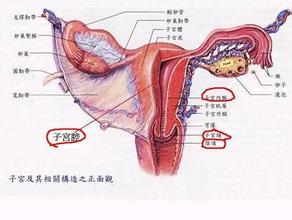 子宫肌瘤