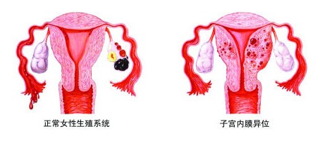 子宫内膜异位